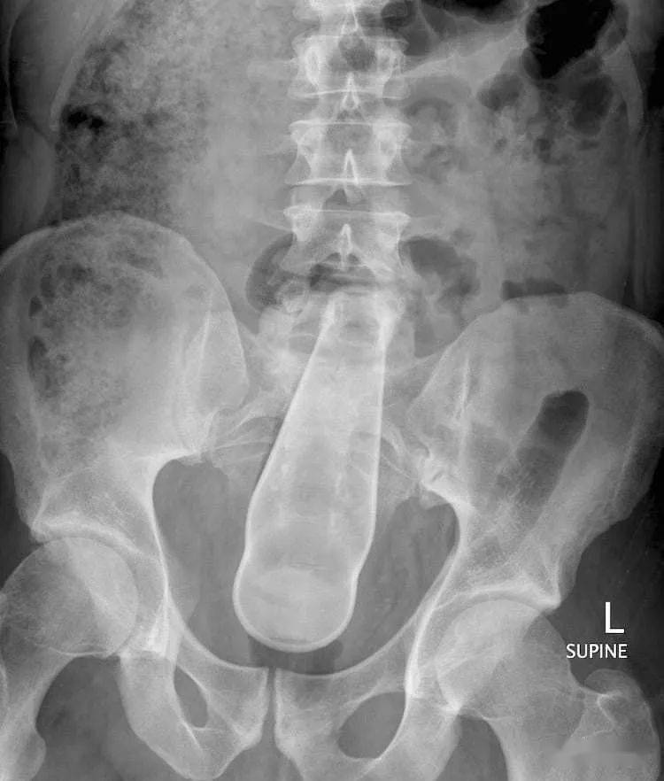 塞2斤金条藏8部手机…人类对肛门的探索太可怕了