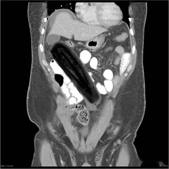 塞2斤金条藏8部手机…人类对肛门的探索太可怕了