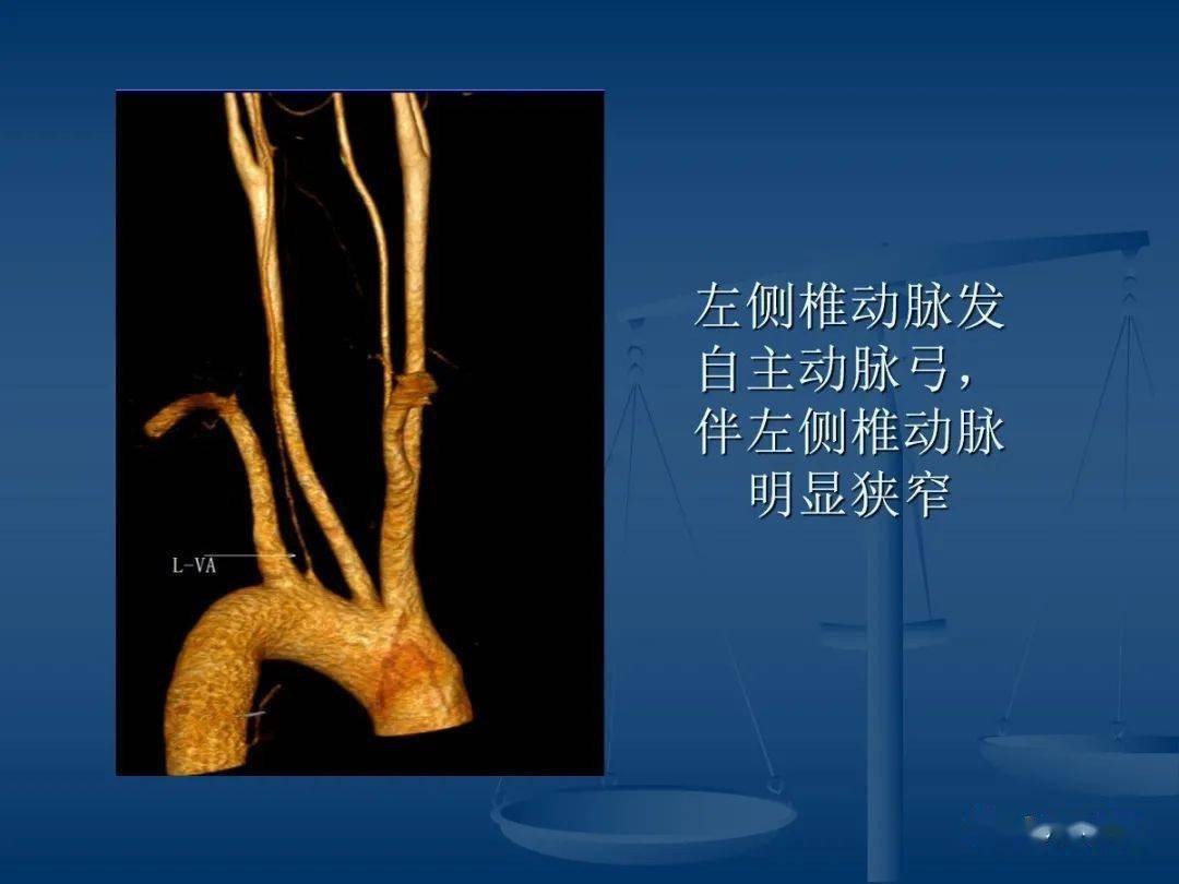 头颈部cta和dsa对血管病变的诊断