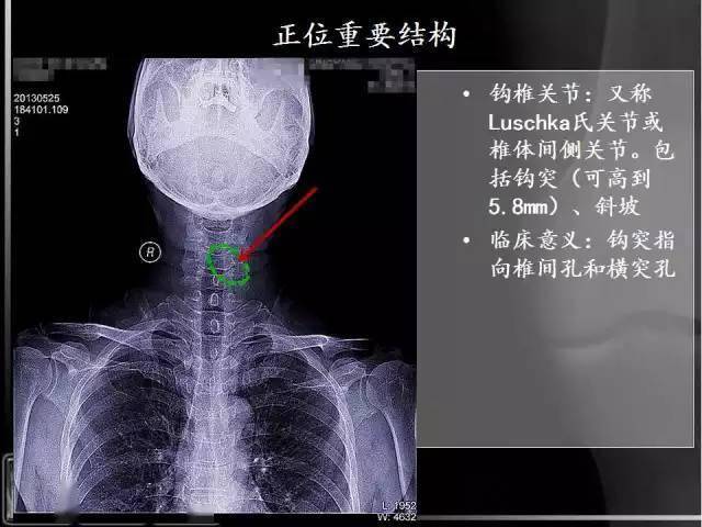 x线解剖详细颈椎x线解读图文标注版