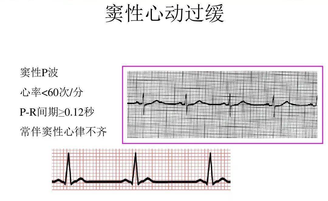 掌握这6项心电图干货波形判断不再难