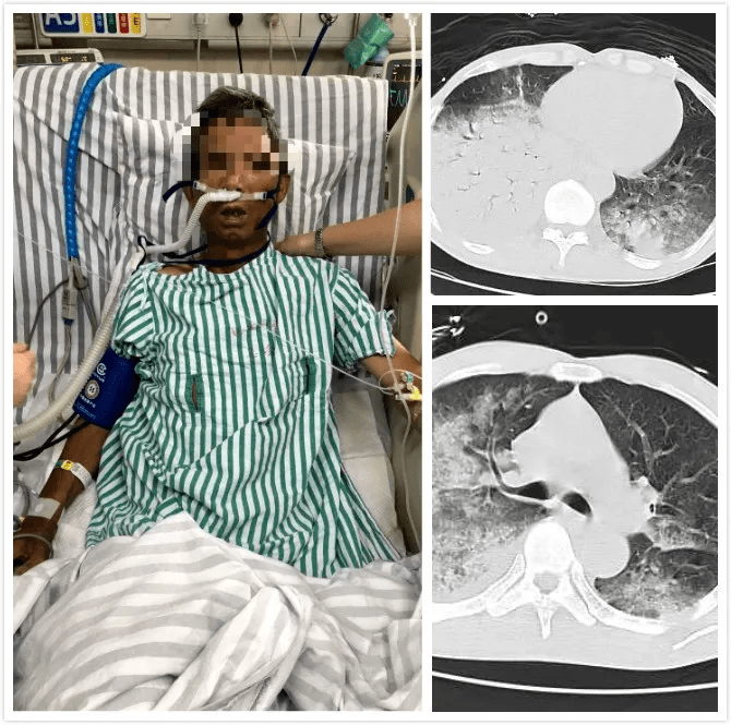 候鸟|杭州男子高烧不退、呼吸困难，竟是感染了“鹦鹉热”！候鸟南迁时需提高警惕