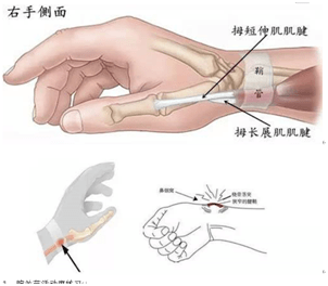 手劳累过度疼怎么办