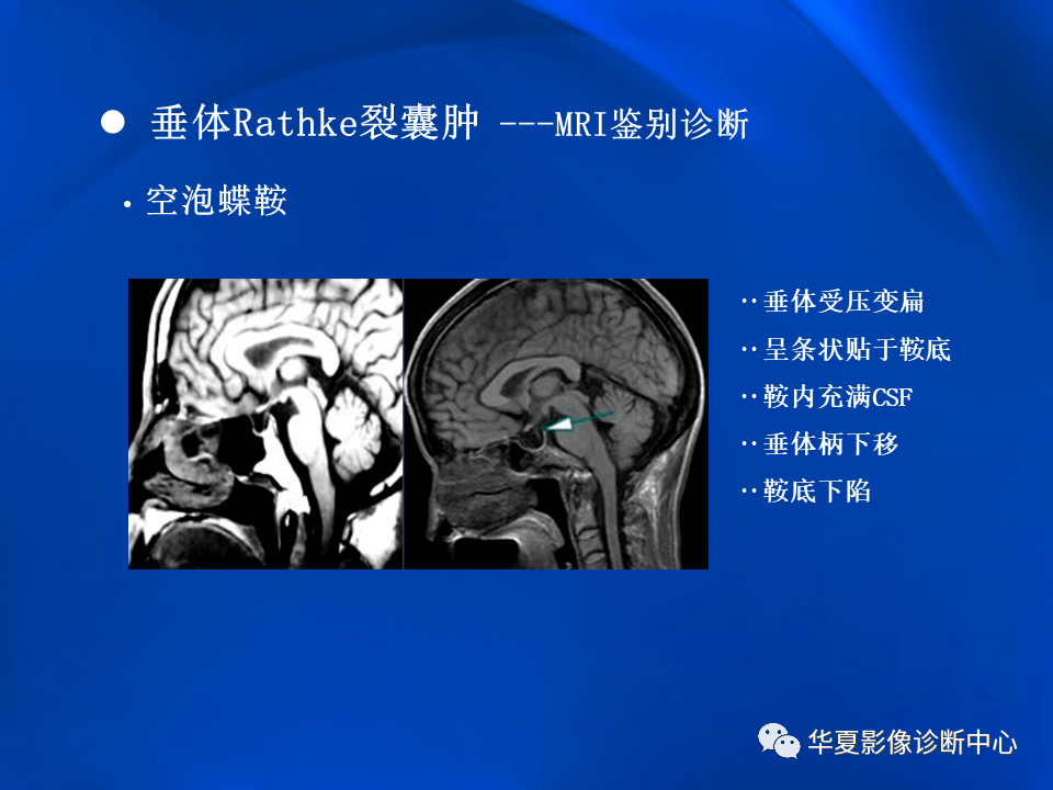 垂体rathke裂囊肿mr表现