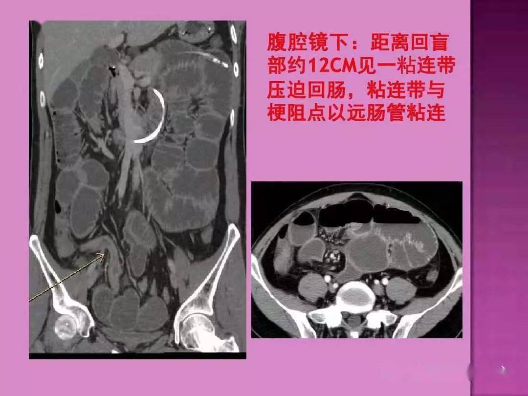 ct上如何寻找肠梗阻的梗阻点