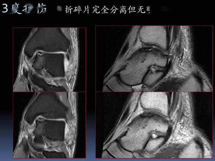 胫骨后肌肌腱撕裂 1.联合韧带(胫腓前韧带)撕裂 6.三角韧带撕裂 1.