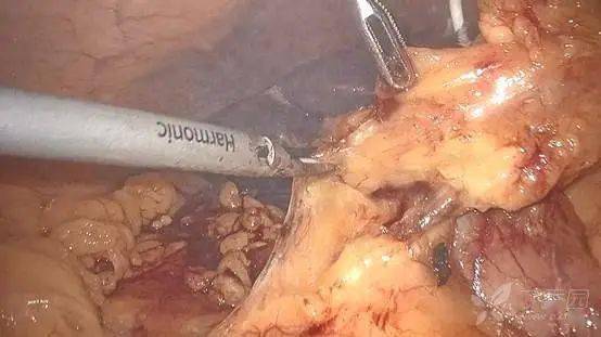 高清图解腹腔镜胰十二指肠切除术多图预警