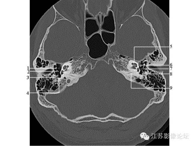 详细标注 | 颞骨hrct解剖图谱