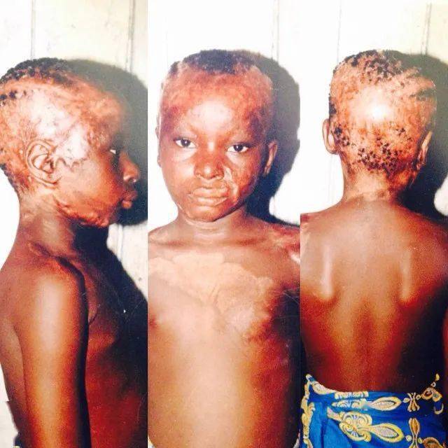 女童|非洲部落9岁毁容女童接受“换头术”，15年后现状曝光看哭网友：这才是顶级美人！