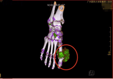 由于患者脚部的痛风石过大,已经侵蚀到骨头,皮肤也被撑大的薄如一张纸