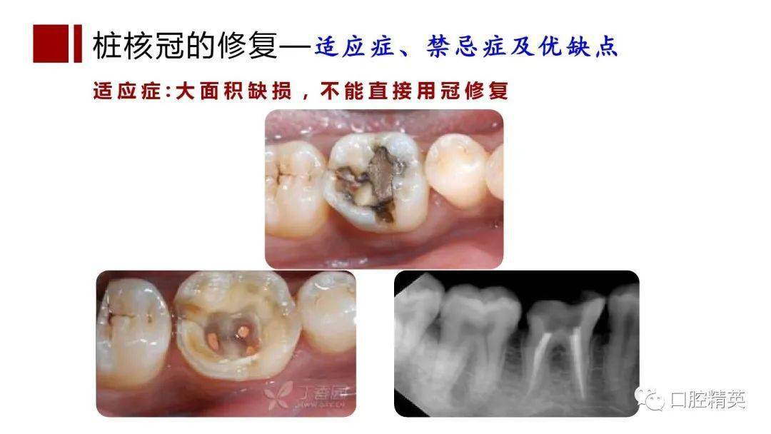 根管治疗桩核选择和桩冠修复