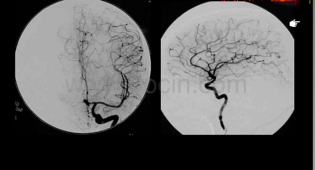 解剖颅内血管丨轻松看懂脑血管造影_动脉