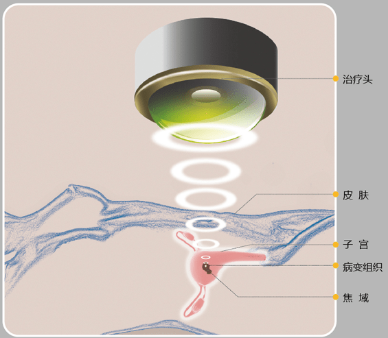 手术|子宫肌瘤的“热”治疗