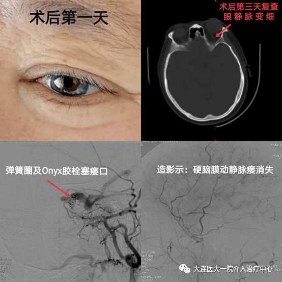 眼球突出充血别忽视脑血管疾病硬脑膜动静脉瘘介入治疗一例