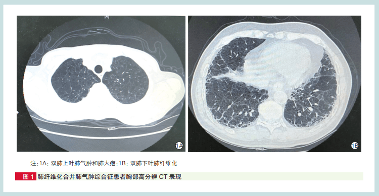 肺气肿合并肺纤维化少见但很危险阜外研究