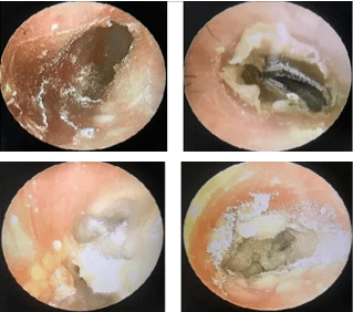 耳真菌病又称为外耳道真菌病,霉菌性外耳道炎,由外耳道内的条件致病