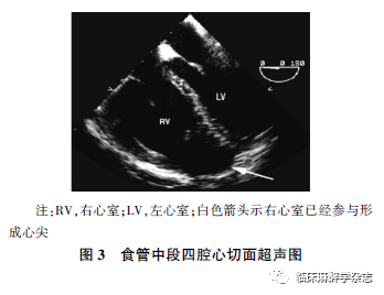 心动图|经食管超声心动图在非心脏手术中应用专家共识 （2020版）