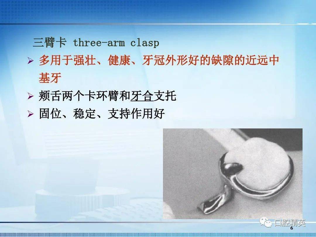 可摘局部义齿卡环的种类