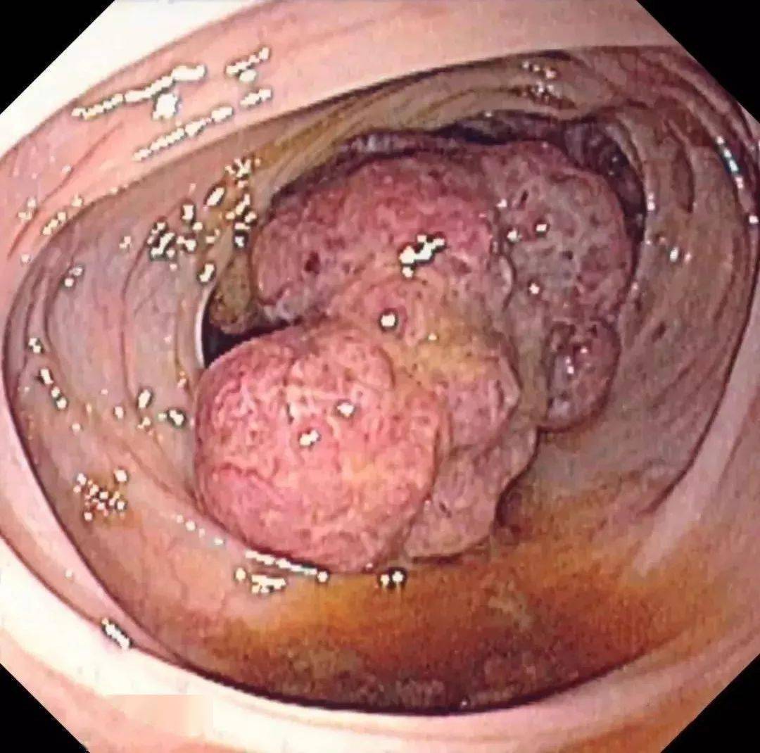 这样的大便,预示着大肠癌的来临!一定要小