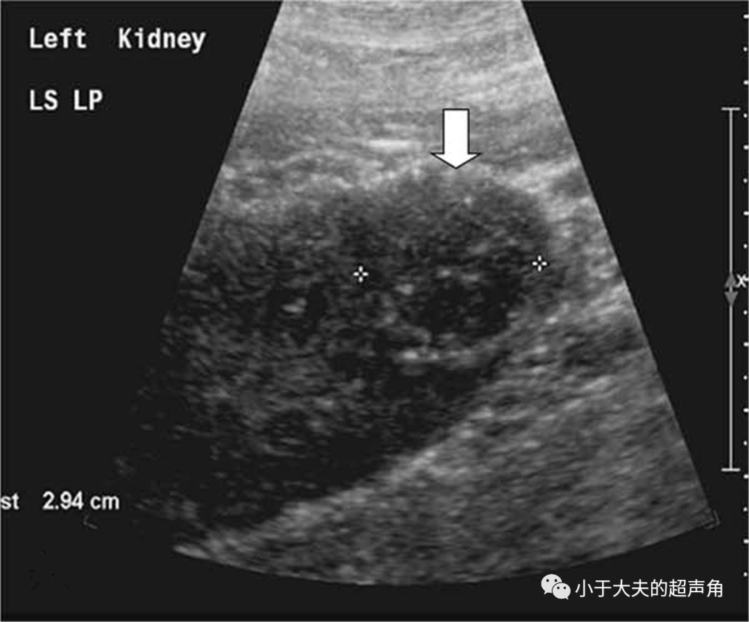 【超声随响】第23期 肾脏castleman病_手机搜狐网