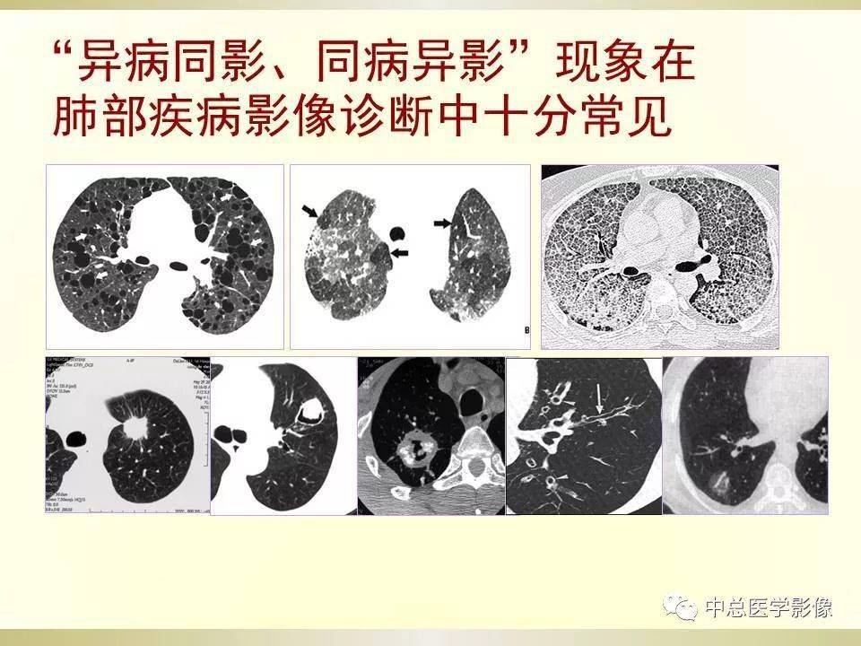 肺部ct征象解读,你都认识吗?