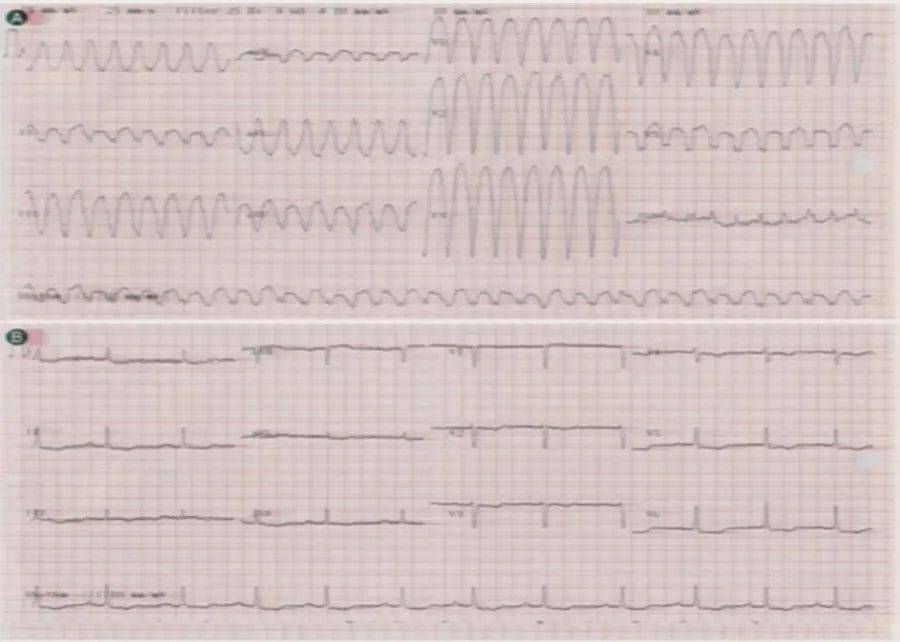 图7 应激性心肌病心电图3 心动过速性心肌病图8.