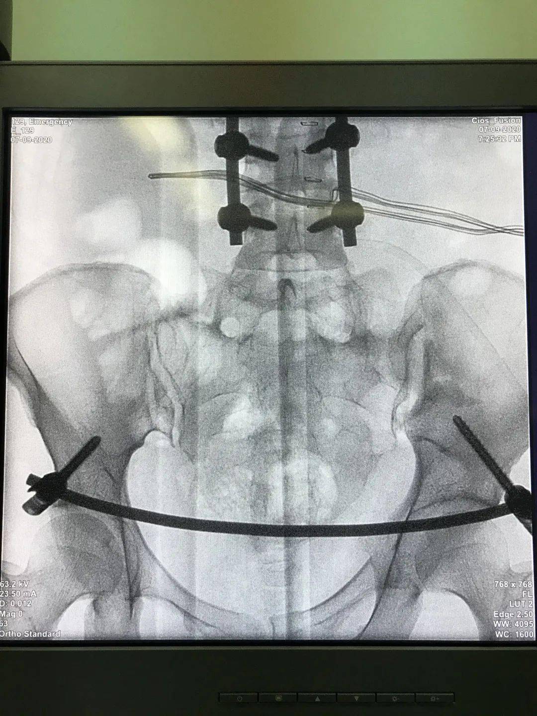 骨盆骨折术前术后此次手术的成功标志着区医院骨盆骨折治疗技术更上