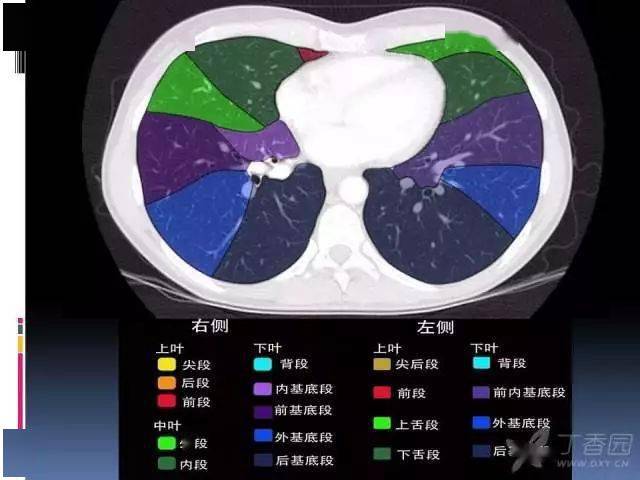 左肺上叶:s1 2:尖后段;s3:前段;s4:上舌段