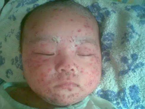 疱疹怎么辨别 76965e9f294a456f992fd3581ad143e3.jpeg