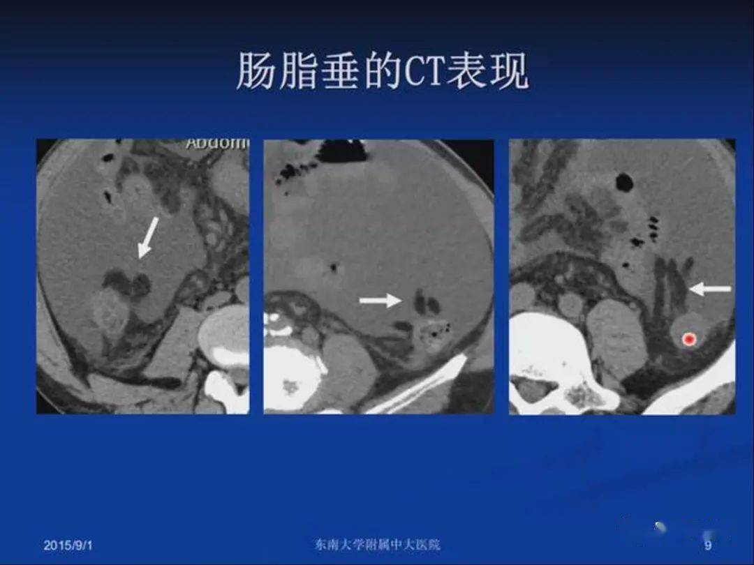 急性原发性肠脂垂炎影像诊断