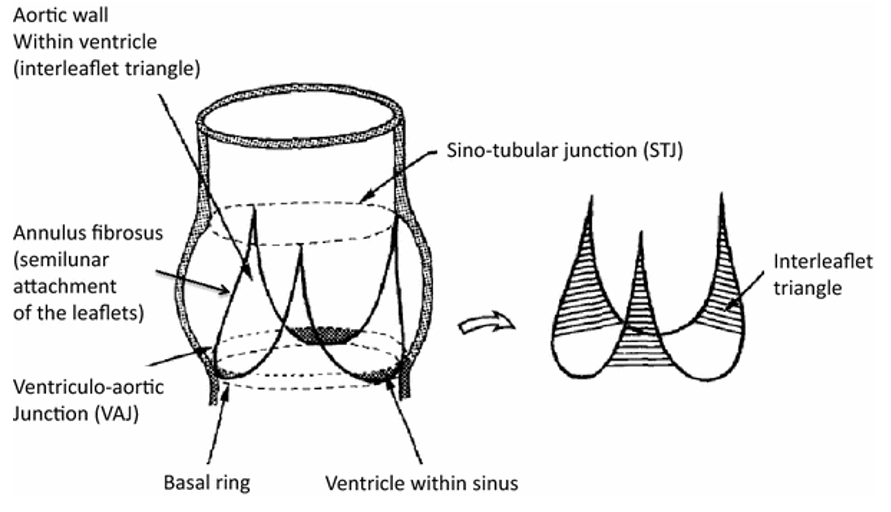 2.为了允许经导管主动脉瓣植入(tavi)在合适主动脉瓣环中 3.