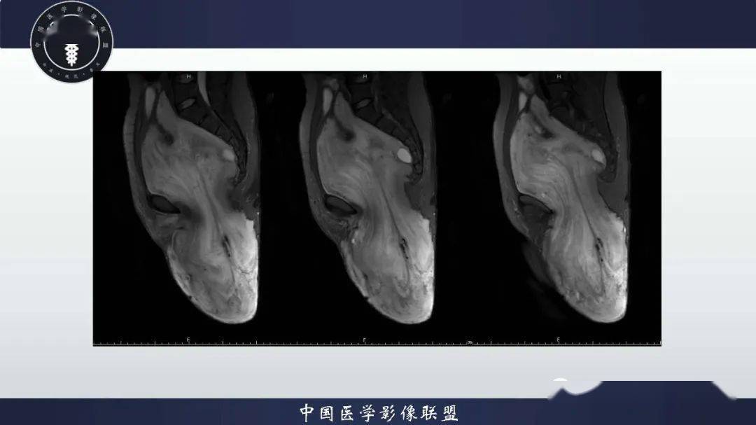 外阴及盆腔丨深部侵袭性血管黏液瘤