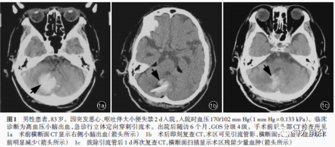 ml|研究 | 立体定向穿刺引流术治疗高血压小脑出血体会