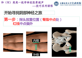 阴部|和（何）亮亮一起学超声技巧系列：超声引导阴部神经阻滞