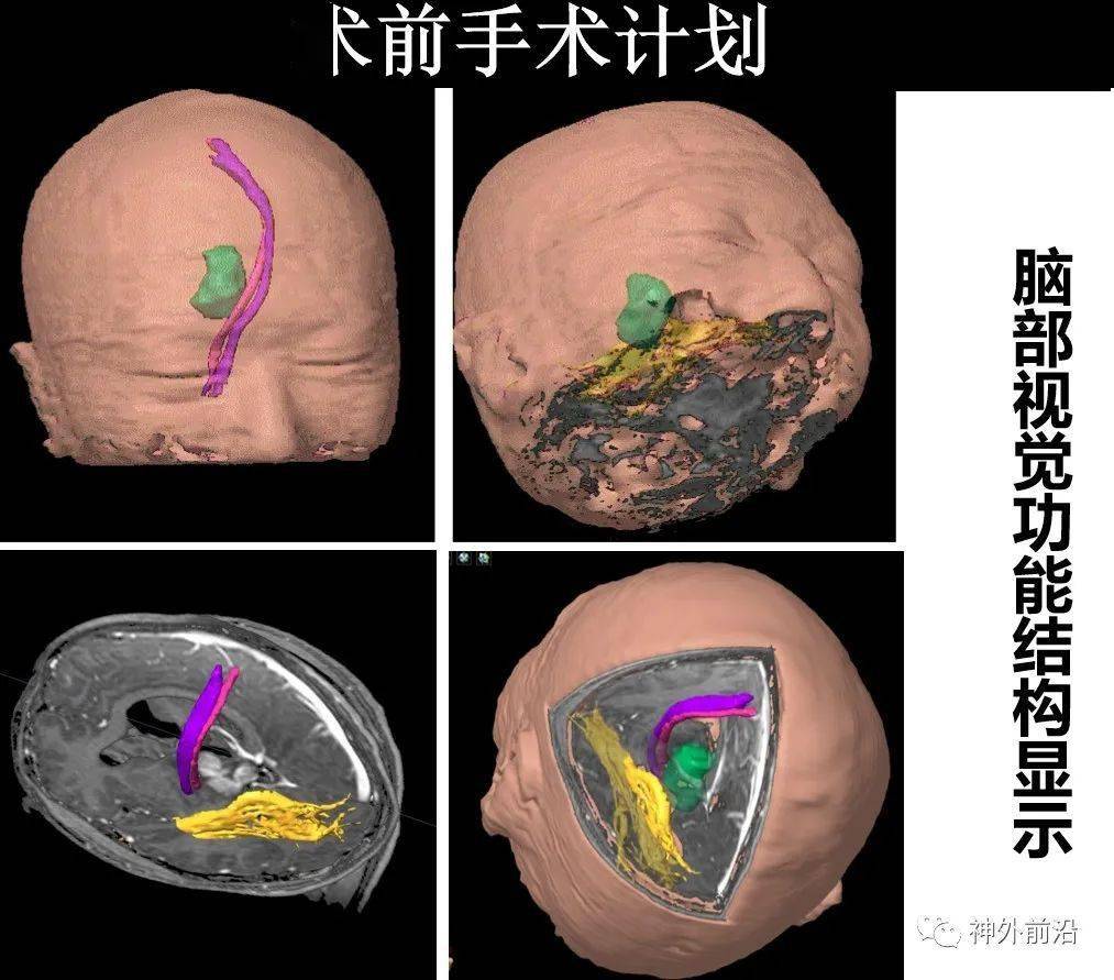 陈晓雷|佳品有约 |如何通过术中磁共振、导航、电生理、超声等实现术中脑功能结构可视化- 许百男 陈晓雷 孙国臣 张家墅