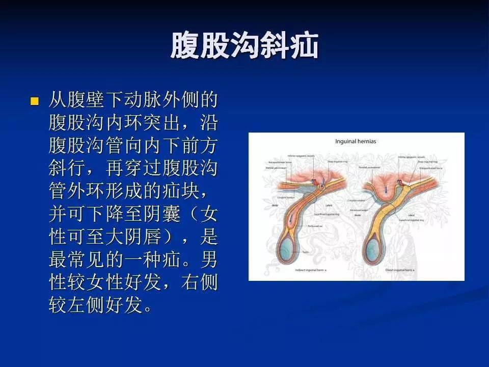 腹外疝影像诊断