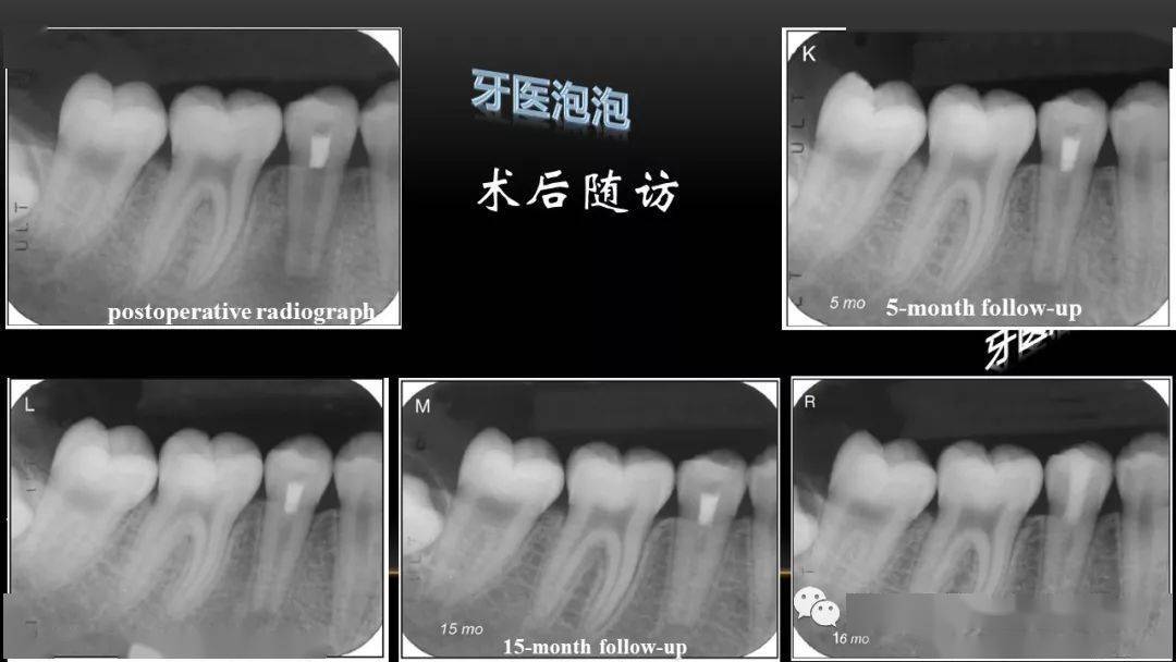 【病例分享】活髓切断术治疗年轻恒牙根尖周炎的病例报道