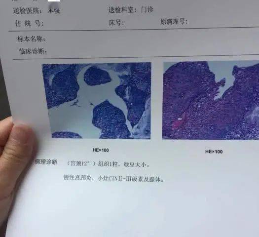 hpv感染进入cin2阶段,能不能只用干扰素来控_宫颈