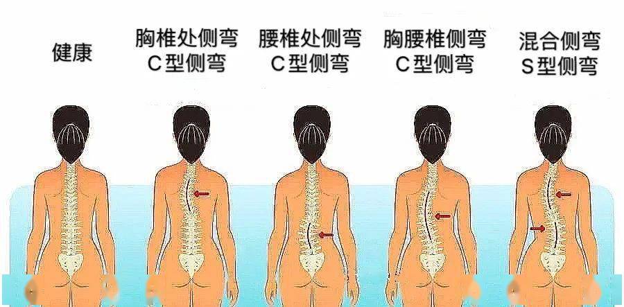 【医文医话】特发性青少年脊柱侧弯的多学科综合治疗模式(一)