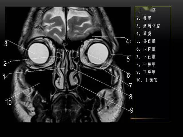 mri下眼部及鼻窦解剖图谱