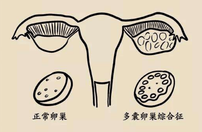 多囊卵巢综合征,英文名字叫  pcos, 是青春期以及育龄女性身上最常见