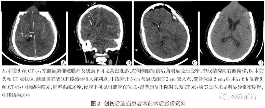 神经|颅内压监测下降阶梯减压技术在创伤后脑疝患者术中的应用 | 中华神经创伤