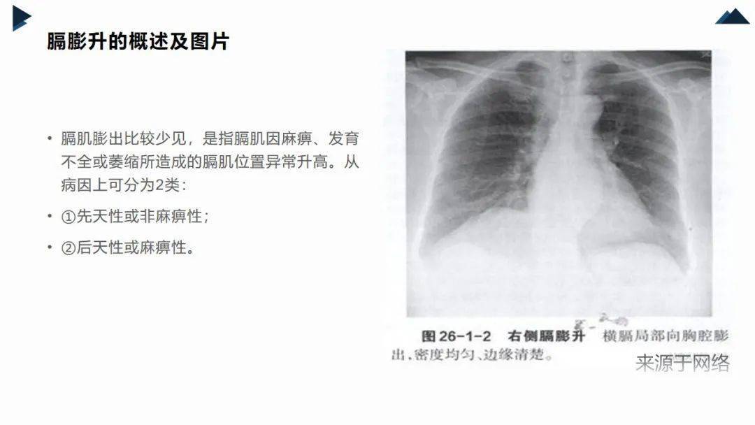 ppt胸腔镜下膈膨升折叠修补术手术室护理查房