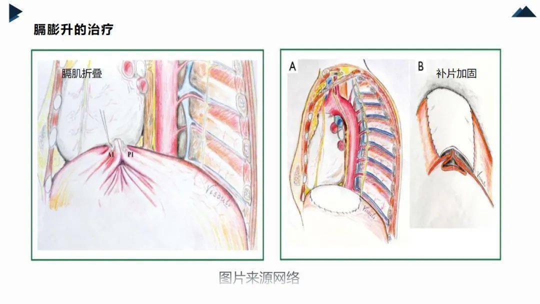 ppt胸腔镜下膈膨升折叠修补术手术室护理查房