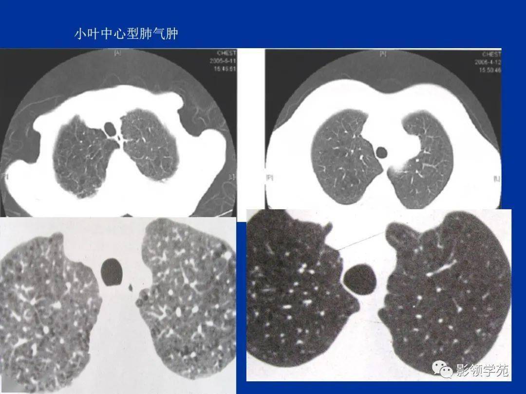 肺小叶,肺间质解剖与病变的hrct诊断