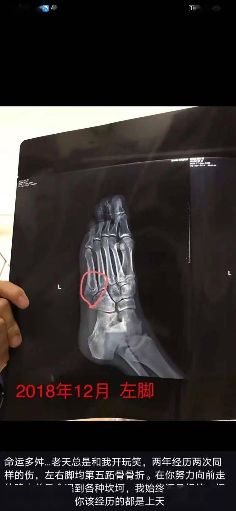 晒出两张脚部的x光片,其中一张是这次受伤的右脚,而另一张是左脚的x光