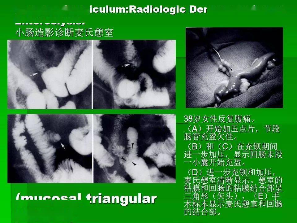 梅克尔憩室综述