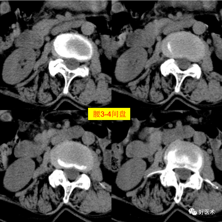 腰3-4间盘膨隆.