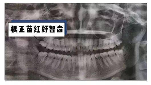 智齿是什么样子的 80bd16fe651e4f228e42fcd5dfb1bfc8.jpeg