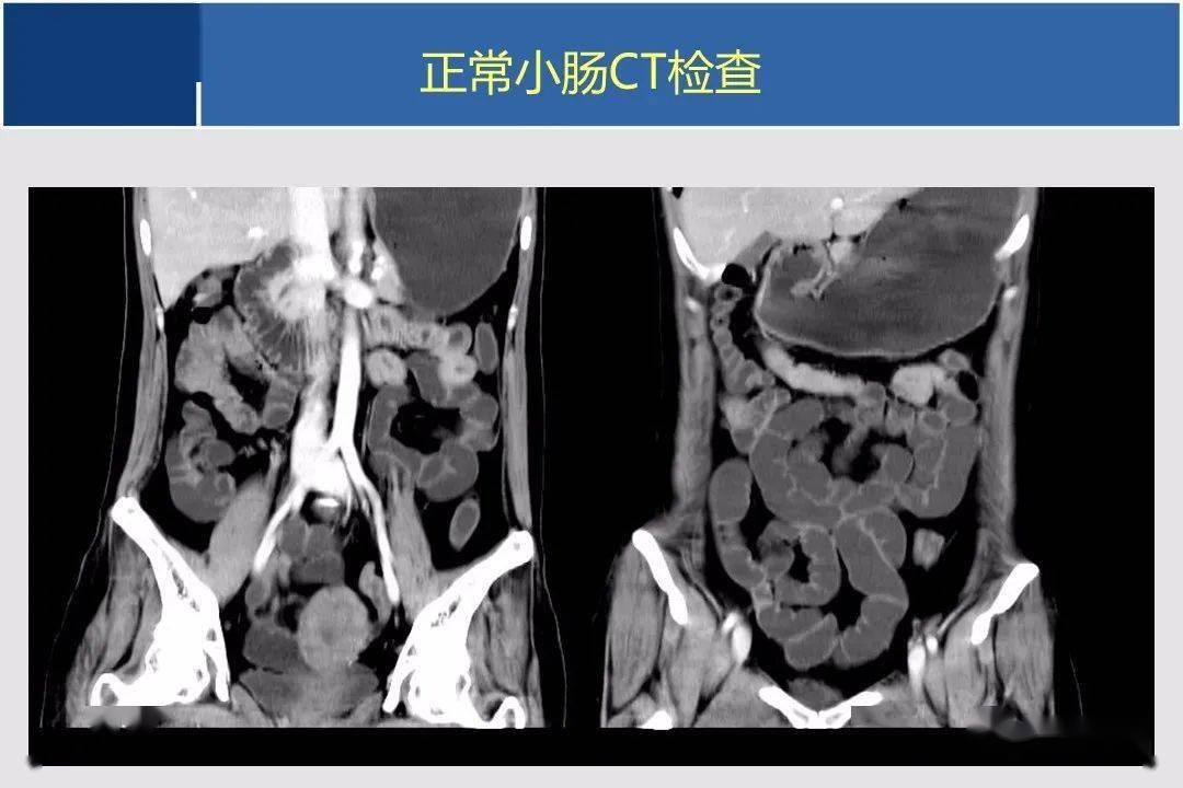 小肠ctmr影像诊断及进展